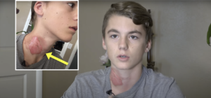 Boy Has Sleepover With Friends, Stunned When He Wakes Up With Severe Burns On His Neck