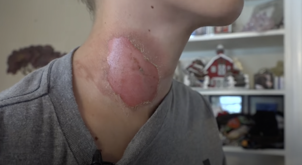 burns3