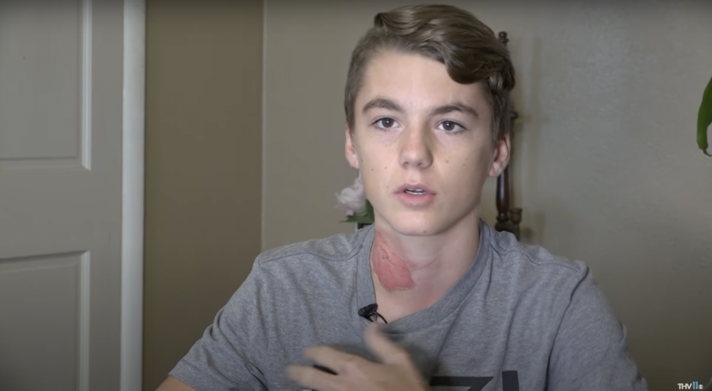 burns4