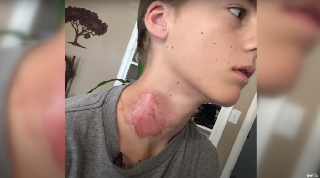 burns5